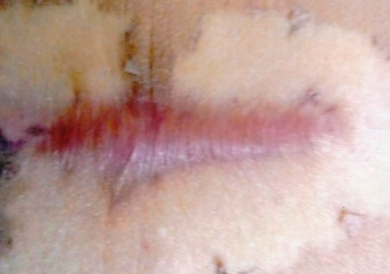 エル・ビューティークリニック 肉割れ・妊娠線、手術跡の治療